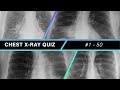 Chest xray quiz 1  50