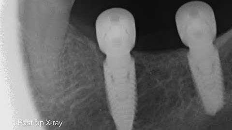 MIS C1 Guided Implant Placement | Ø4.20x11.50mm, Ø4.20x10mm | Mandible Jaw