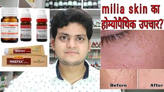 Milia! Homeopathic medicine for Milia? Milium Cyst! Explain!