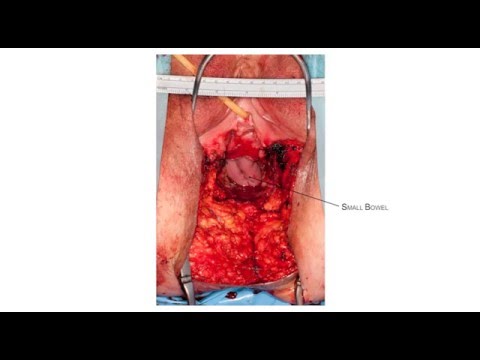 Hybrid Robotic Posterior Pelvic Clearance For Rectal Cancer