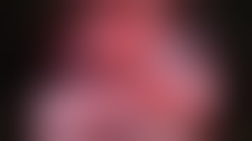 Pulmonary Artery Dissection using TSS