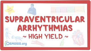 Supraventricular arrhythmias: Pathology review
