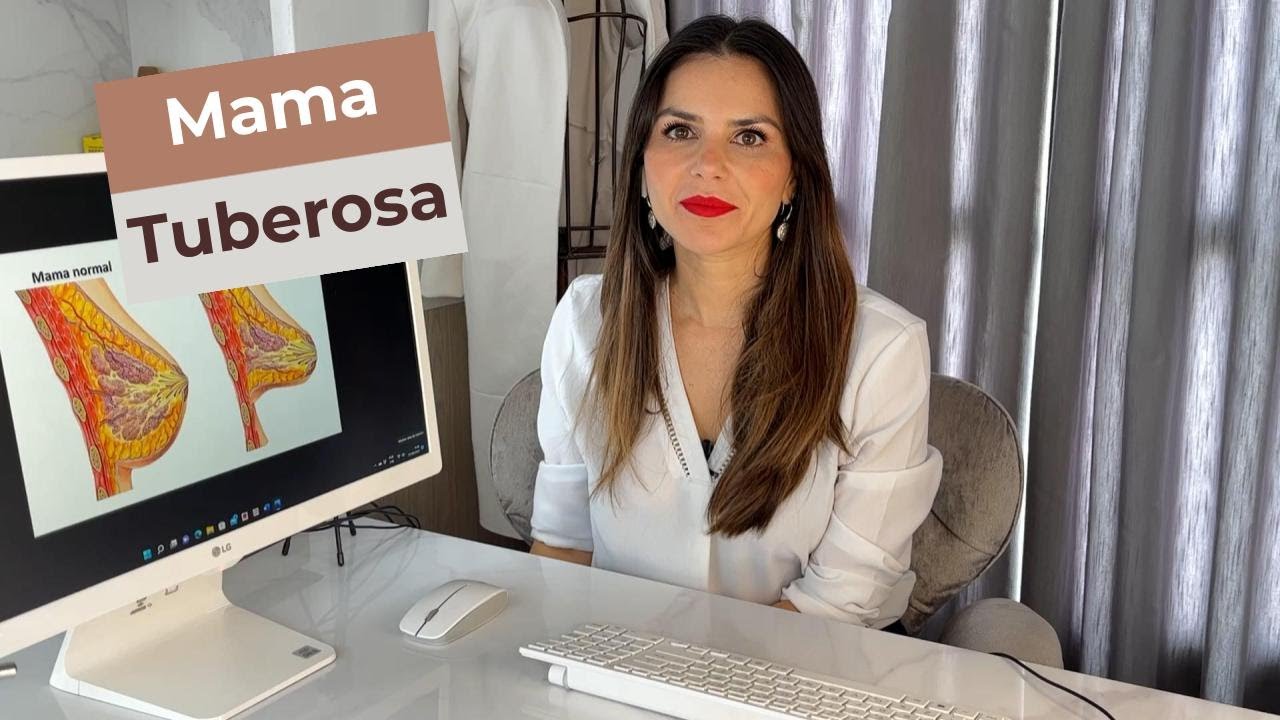 Mama Tuberosa o que é e como tratar mamas com tamanhos e formas ...