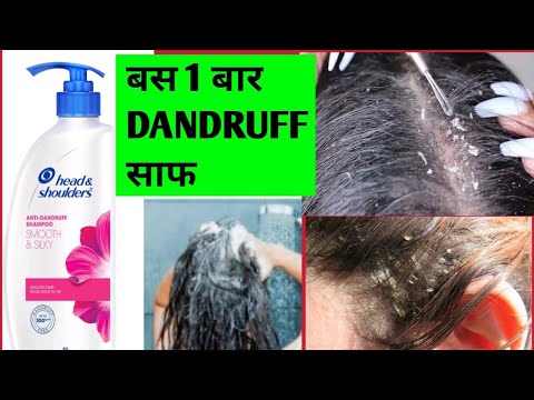 100% dandruff free scalp in 1 day👍 Head & shoulder anti-dandruff smooth and silky shampoo review