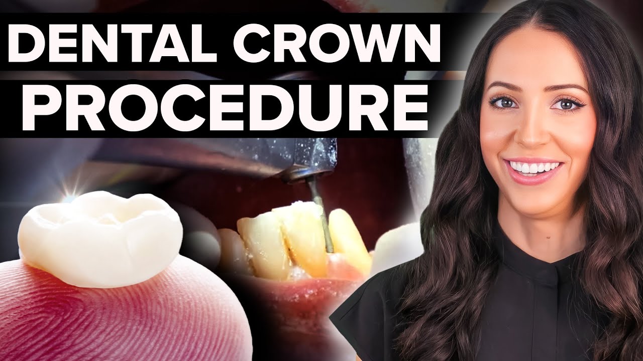 Outline Video Same Day Dental Crown Procedure Step by Step