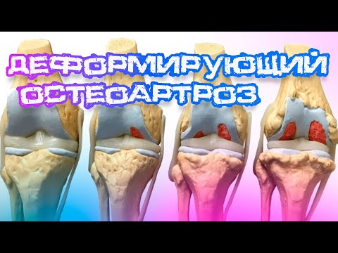 Что такое деформирующий остеоартроз? Причины, степени и симптомы деформирующего остеоартроза