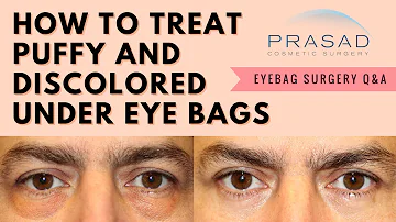 Puffy Eye Bags and Dark Circles - Removing the Fat, and Regenerating Eyelid Skin with PRP