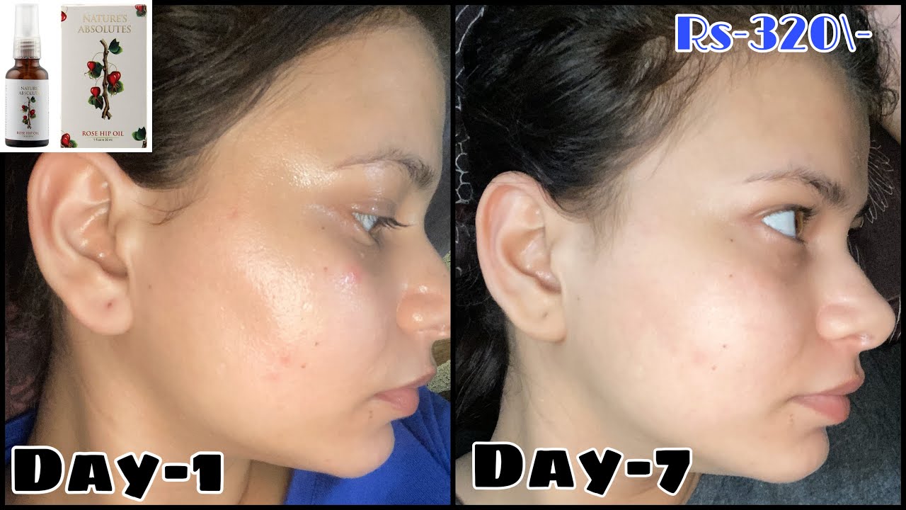 I Tried Cold Pressed Rosehip Oil For A Week Acne Marks And Blemishes Surprised Youtube I Tried Cold Pressed Rosehip Oil For A Week Acne Marks And Blemishes Surprised Youtube