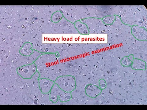 Heavy load of parasites in stool||  Stool microscopic examination||  Trichomonas hominis