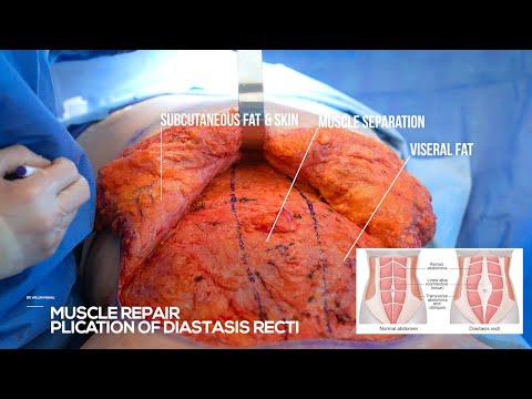 What Causes Stomach Fullness? Live Tummy Tuck Muscle Plication & Fullness Explained!