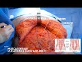 What causes stomach fullness live tummy tuck muscle plication  fullness explained