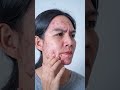 Overcoming Face Scars Before Marriage | Interview with Dr. M. Bhanu Murthy