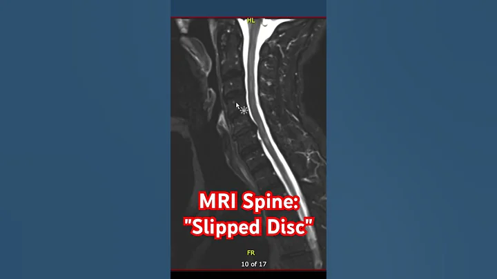 MS and a Slipped Disc? 😭