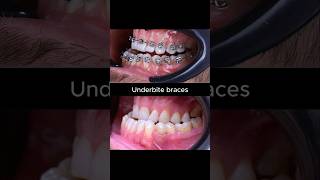How to fix underbite teeth with braces #braces #dentist #orthodontist