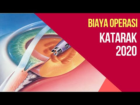 Biaya Operasi Katarak Terbaru 2020 di Rumah Sakit dan Klinik Mata