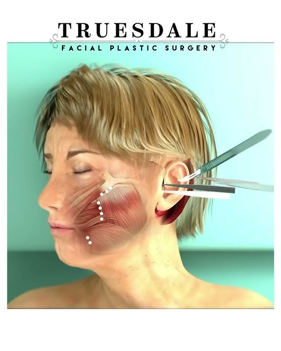 What is a Deep Plane Facelift?