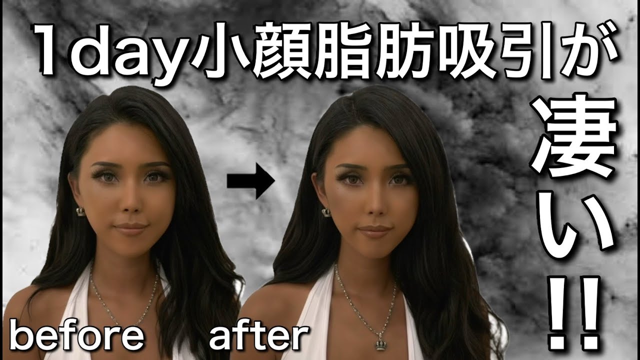 1日で終わる1day小顔脂肪吸引してきた🤍葉山潤奈