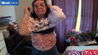 Shock Video: Bizarre Disease In The World - Neurofibroma Syndrome