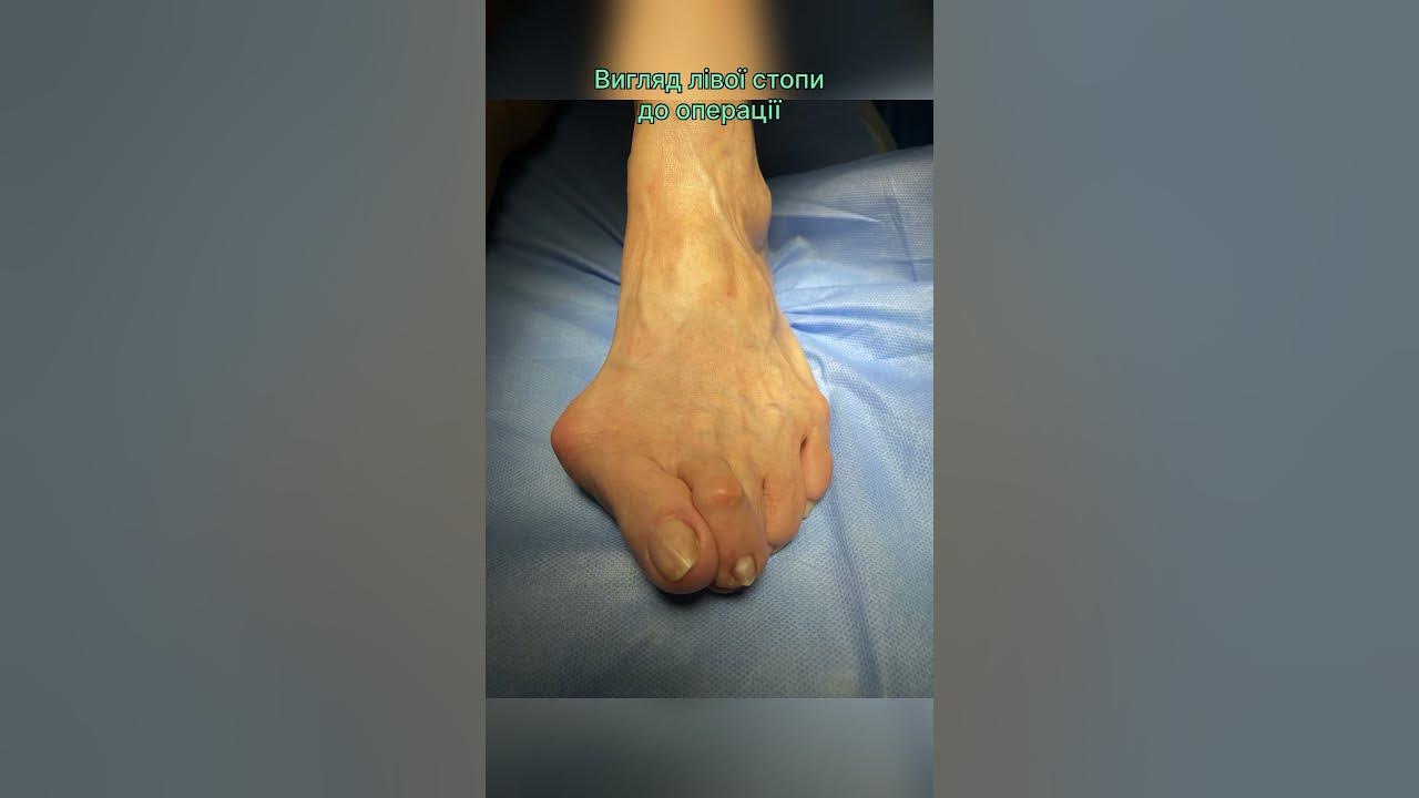 Вальгусна деформація 1 пальця та гакоподібна деформація 2 пальця стопи ...