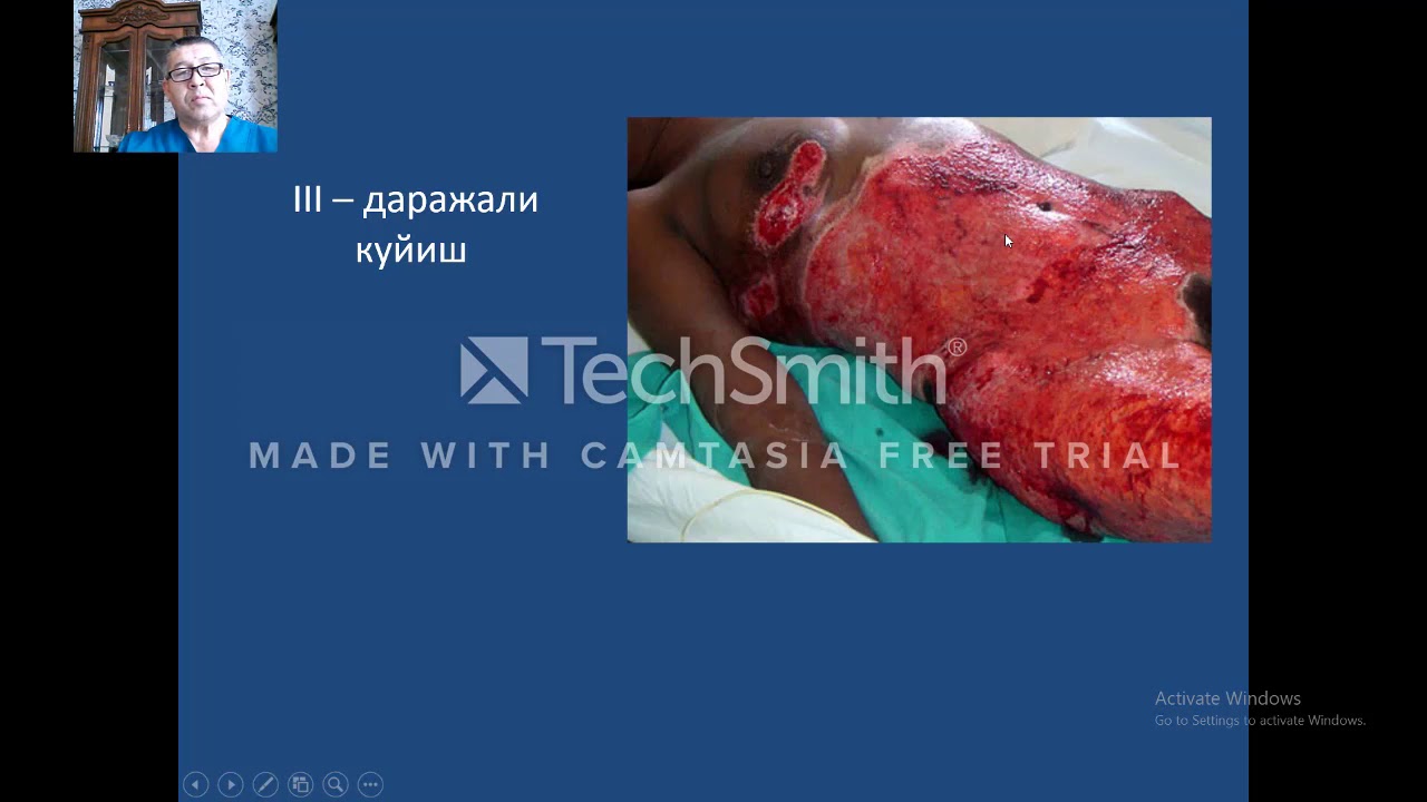 Термик шикастланишлар  Куйиш