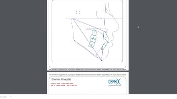 CephX | Downloading Cephalometric Analysis