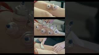 Cupping & Gousha Knife treatment
