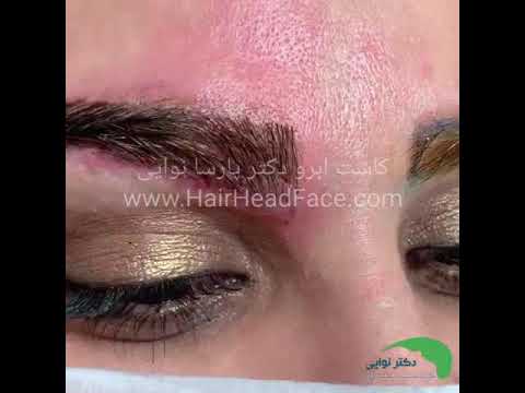 فیلم برداشتن مو از پشت سر برای کاشت ابرو کلینیک دکتر پارسا نوایی در اصفهان
