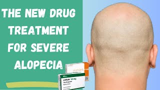 OLUMIANT & LITFULO, How Effective Are These Hair Loss Drugs For Hair Growth in Severe Alopecia