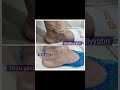 Topuqlarda qaralma kapilyar partlamasi qansizma genislenmis kapilyarlar göyerme damar ulduzcuqlari