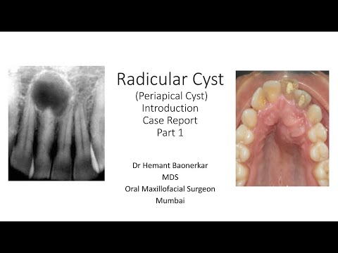 Radicular Cyst / Periapical Cyst / Case Report Series Part 2