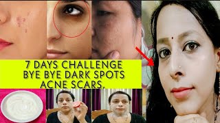 In 7days Remove Dark Circle,Acne Scars,Pigmentation/100% Result Natural Home Remedy For Glowing Skin