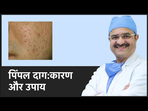 पिंपल दाग:कारण और उपाय (Acne Scar: Causes & Treatments) | ClearSkin, Pune | (In HINDI)