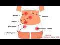 Hernia | surgery | Wael Revision Azhar