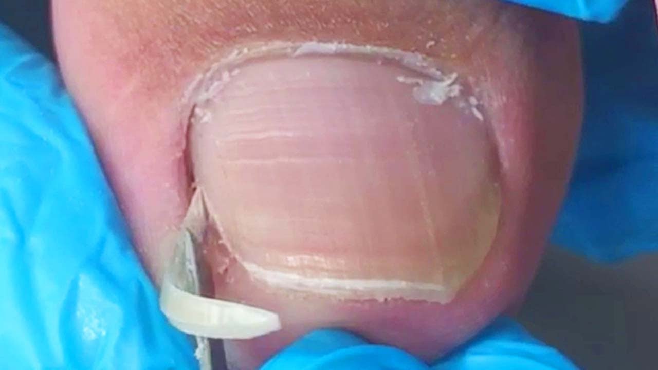 Complete trimming process for extra long ingrown toenails! YouTube