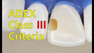 ADEX Criteria for CLASS III Composite Preparation