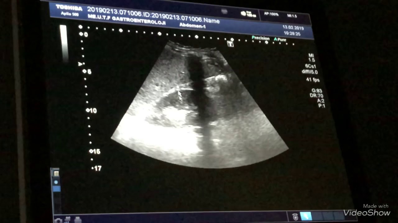 Pankreasta kitle , kist ve karaciğer usg. Pankreasmasse, Zyste und Leber Ultraschlall.