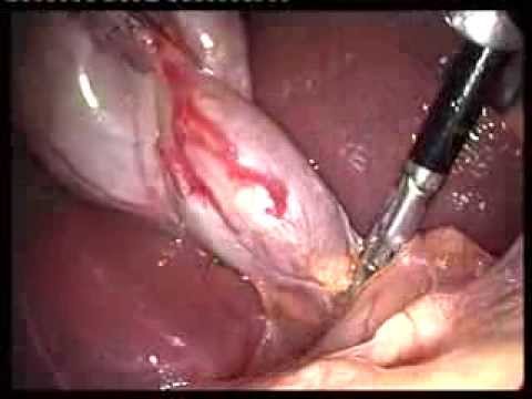 Laparoscopic Videos (edited-2)- Lap Chole In Acute Cholecystitis Within 3 Days