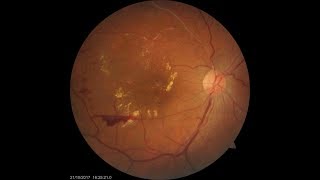 Treatment for Retinal Vein Occlusion