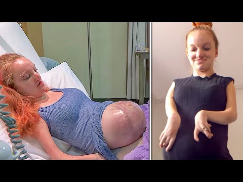 This Woman Was Born With Nearly No Body Muscle, But She Defied Doctors To Carry A Baby To Term