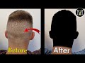 Ive tried microneedling my fue scars and heres what i found