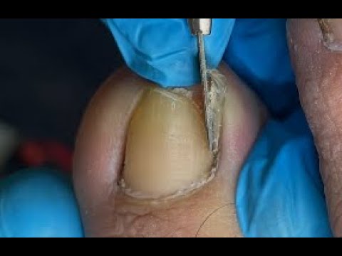 Ingrown toenail | Large spicule #podologiaintegral