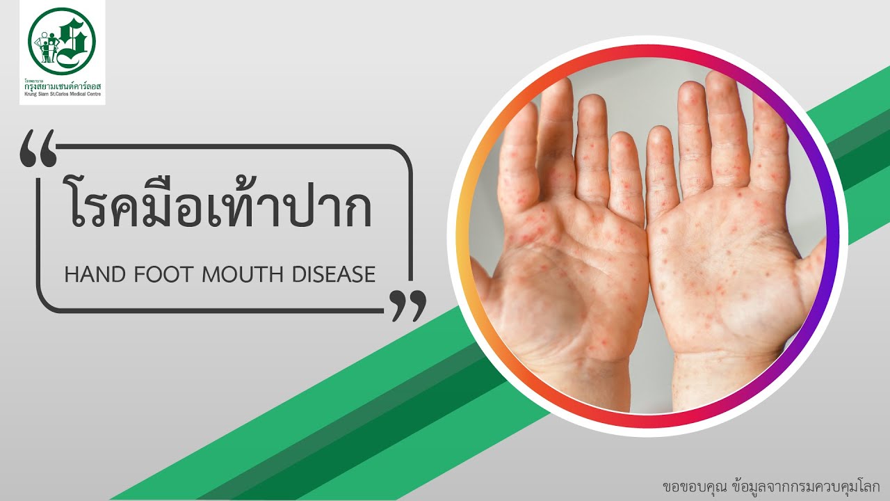 โรค มือ เท้า ปาก Hand Foot Mouth Disease | โรงพยาบาลกรุงสยามเซนต์คาร์ลอส