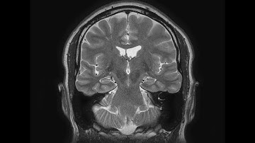 MRI brain scans