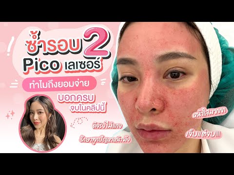 (No Sponsor) รีวิวจัดหนัก!!! Pico เลเซอร์ แพงไหม เห็นผลรึป่าว บอกหมดในคลิปนี้ |เอ้ว่าดี