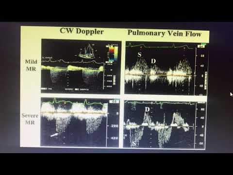 Mitral regurgitation flow reversal in pulmonary vein