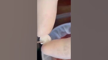 dental veneers | laminate teeth | Your dentist #veneers #dentistry #dental