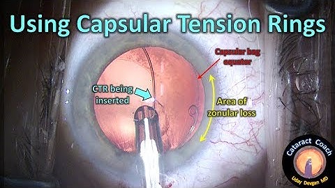 Using Capsular Tension Rings in Cataract Surgery with zonular loss