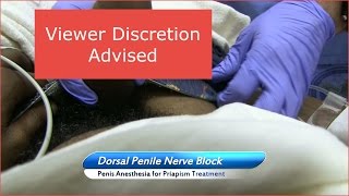 Dorsal Penile Nerve Block (Viewer Discretion Advised)