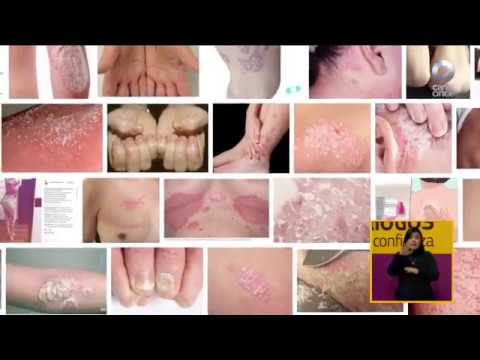 Vídeo: ¿Viviendo Con Psoriasis? Tienes Esto