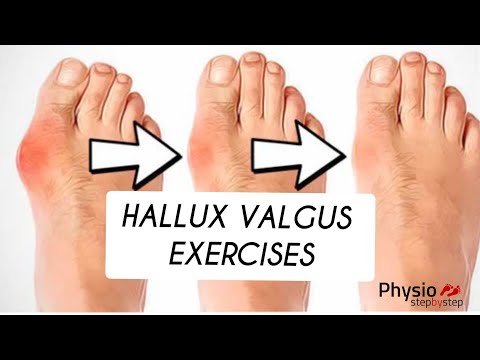 HALLUX VALGUS correction exercises (IG@physiostepbystep)